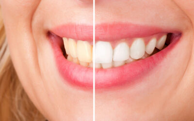 Blog 11 Teeth Whitening Near Me