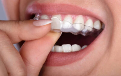 Blog 9 Invisalign vs Braces