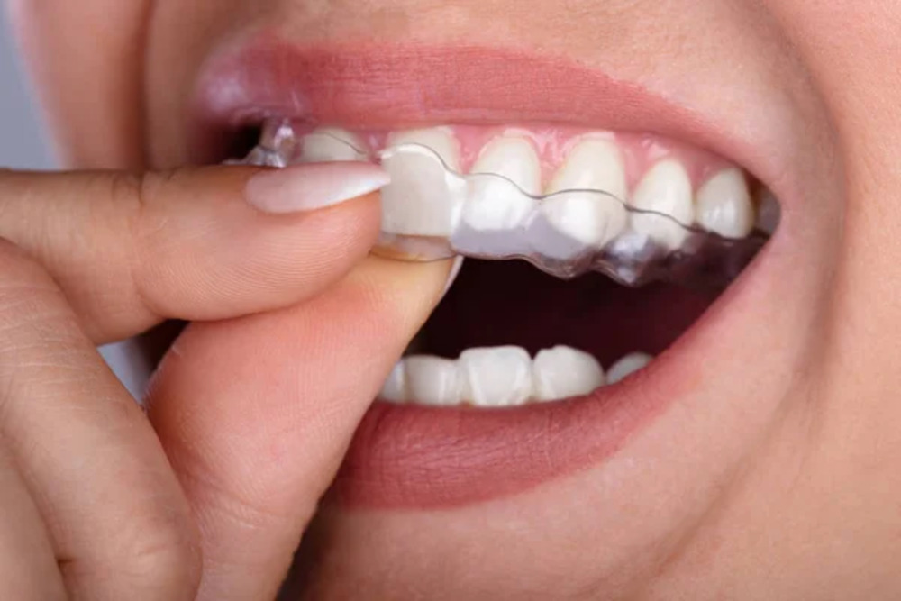 Charles E. Boren | Invisalign Attachments Invisalign Implant