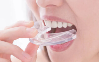 Blog 5 Mouth Guard for Teeth Grinding
