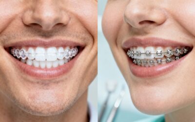 Blog 8 Orthodontist Braces for Adults