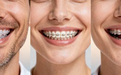 Blog 5 Cosmetic Dentist Near Me: Best Clear Braces for Adults in Bellaire, TX