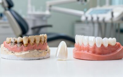 Blog 4 Dental Veneers Before and After