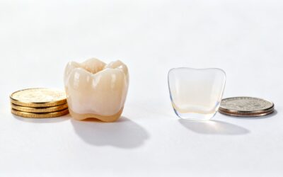 Blog 8 Cosmetic Dentist in Bellaire, TX: Veneers vs Lumineers Cost Guide