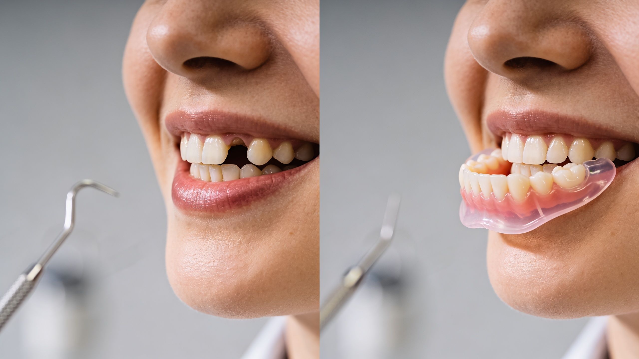 7 Before And After Valplast Partial Denture Examples 7 Before And After Valplast Partial Denture Examples