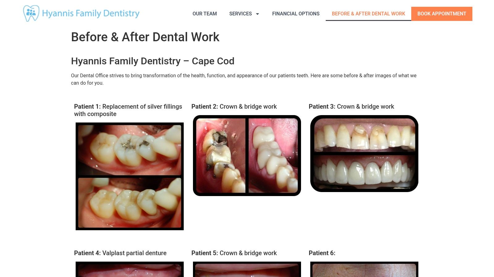 7 Before and After Valplast Partial Denture Examples 4 Hyannis Family Dentistry, Before & After (Patient 4: Valplast Partial Denture)