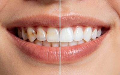 Stunning Cosmetic Dentistry Before and After