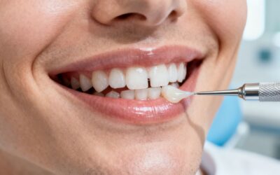 Blog 10 Cosmetic Dentist in Bellaire, TX: How to Fix Gaps in Teeth Without Braces