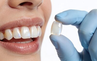 Charles E. Boren | Stunning Smile Makeover: Veneers On Front Four Teeth Stunning Smile Makeover: Veneers On Front Four Teeth